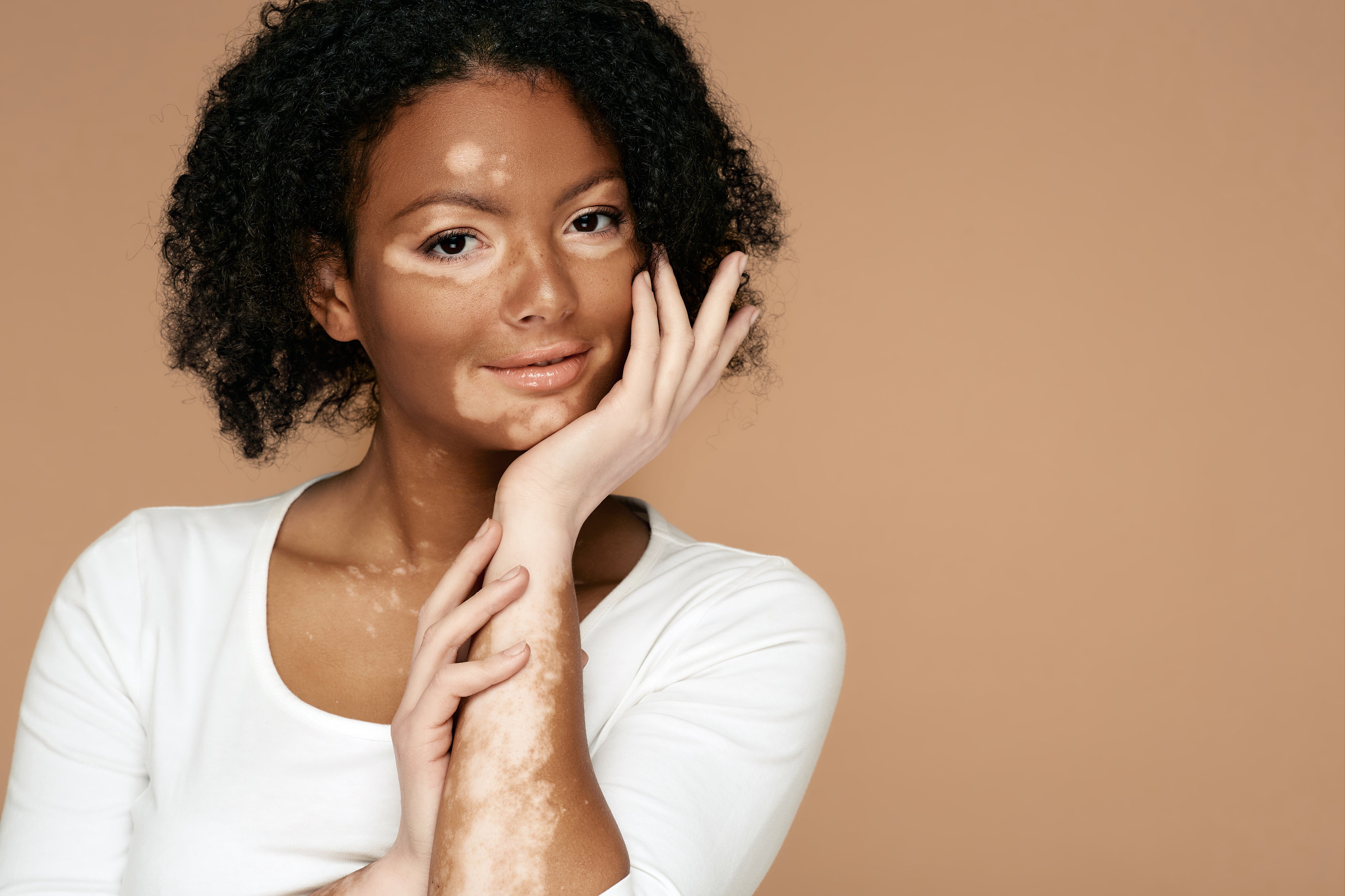 Makeup To Er Vitiligo Easy Steps
